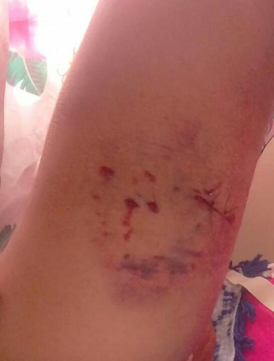 Cuidadora de idosos sofre ataque de cão pitbull em Jequié Cuidadora de idosos sofre ataque de cão pitbull em Jequié