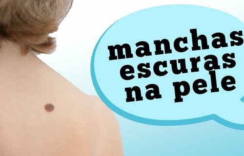 MELANOMA: Quando uma mancha escura na pela pode ser sinal de câncer MELANOMA: Quando uma mancha escura na pela pode ser sinal de câncer