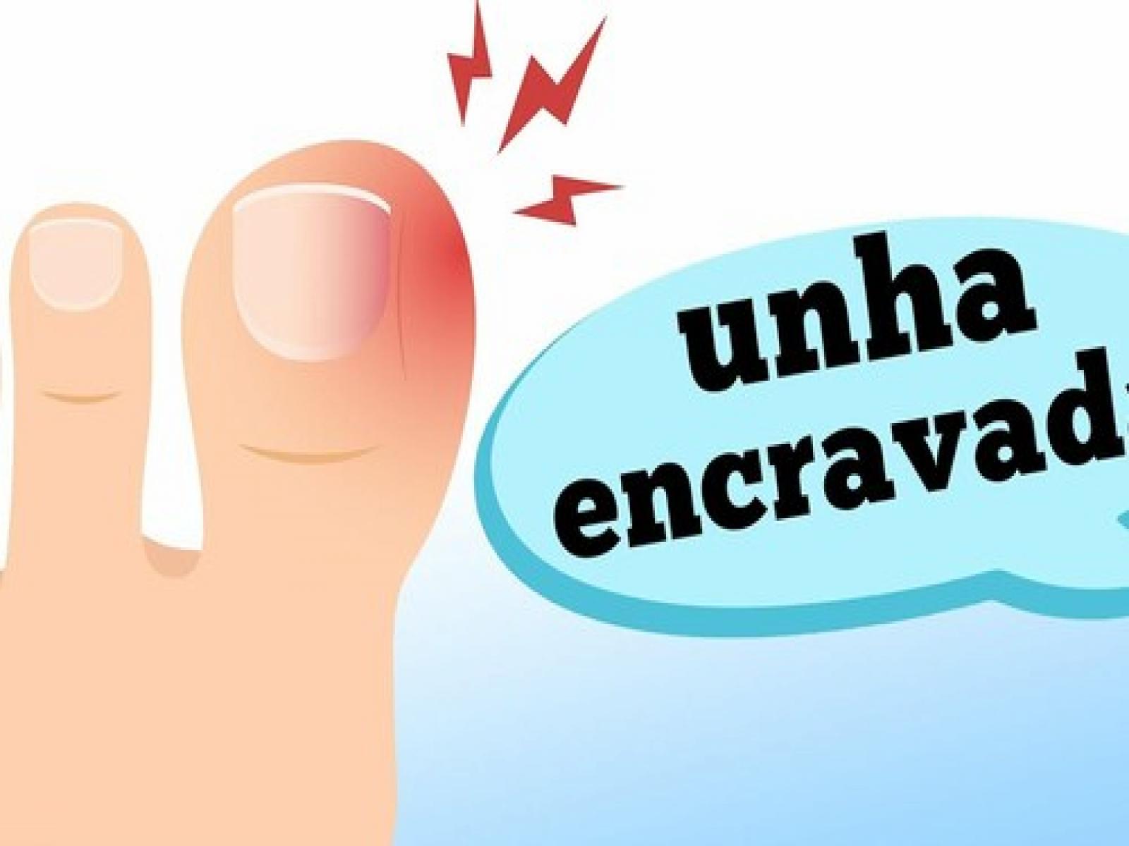 O que causa unha encravada?