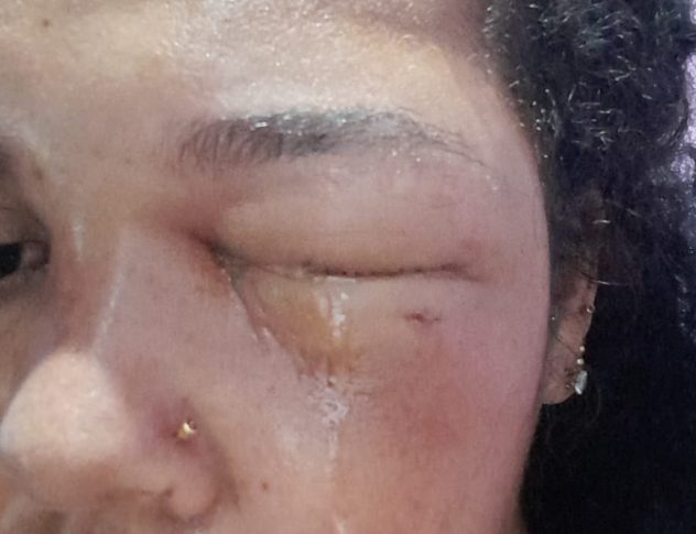 Ipiaú: Cachorro ataca e morde mulher no rosto no bairro São José Operário Ipiaú: Cachorro ataca e morde mulher no rosto no bairro São José Operário