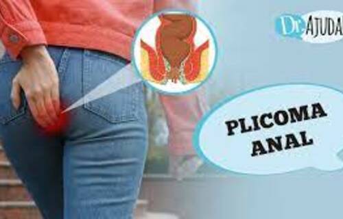 Plicoma Anal: o que é e como tratar? Plicoma Anal: o que é e como tratar?