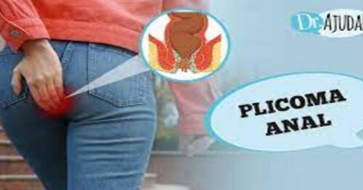 Plicoma Anal: o que é e como tratar?