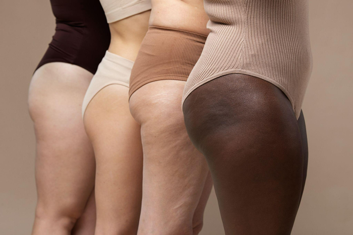 Emagreceu, mas as pernas continuam volumosas? pode ser sinal de lipedema?