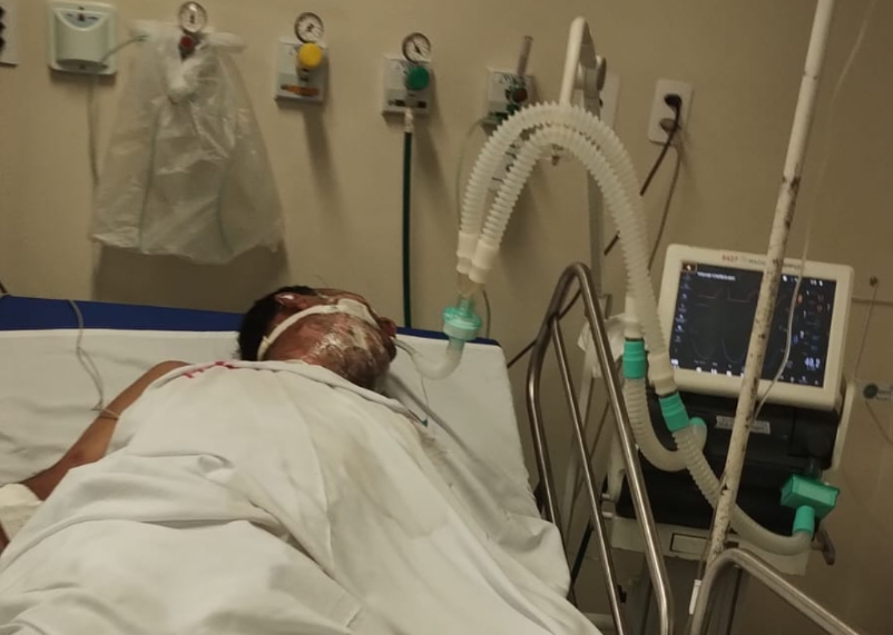 Lavador de carros queimado em Jequié segue em estado grave na UTI do HGE