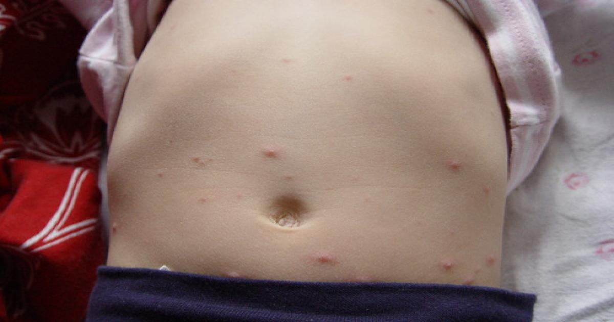 Bahia registra 443 casos de catapora até a Semana Epidemiológica 32