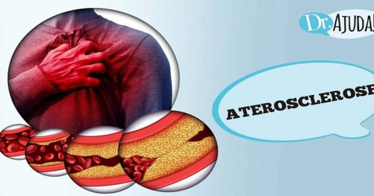 O que é aterosclerose? Quais os sintomas e os fatores de risco?