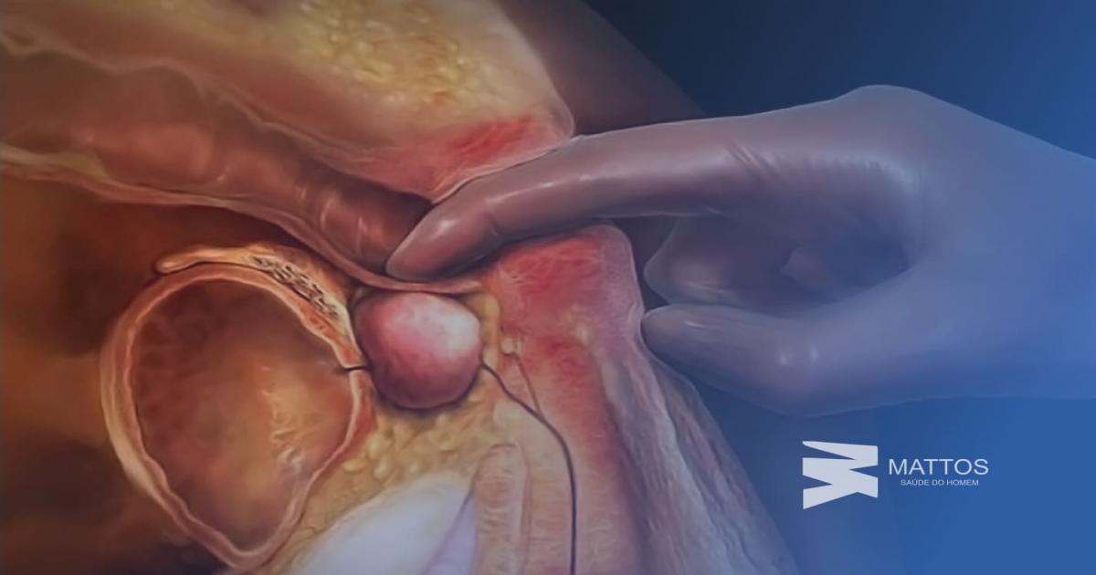 Novembro Azul: preconceito ainda é obstáculo para a prevenção do câncer de próstata